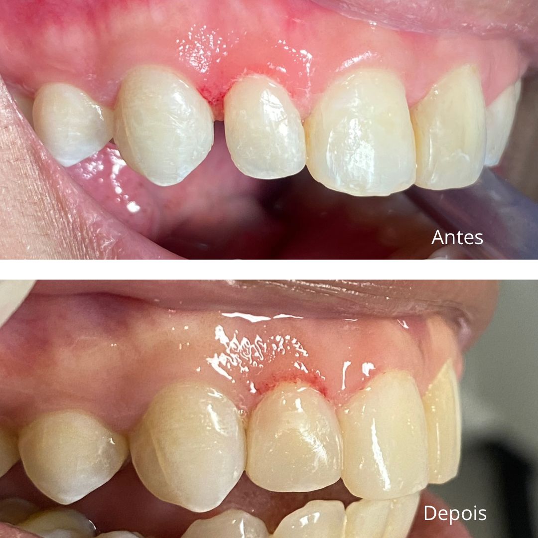 Antes e Depois Facetas